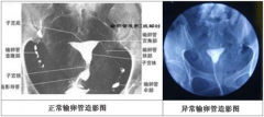 郑州不孕不育医院|输卵管造影疼吗？对身体有没有危害？