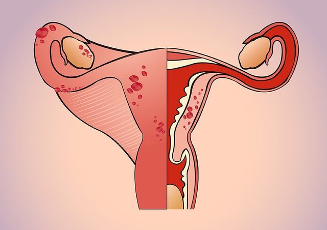 子宫内膜异位症是什么原因引起的
