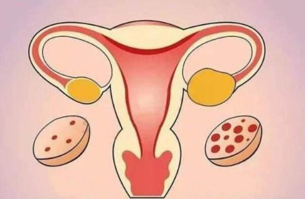 多囊卵巢还能怀孕吗？该怎么治疗