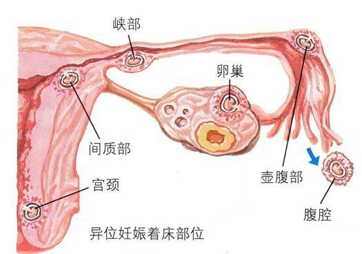 只有一侧输卵管通畅还能怀孕吗