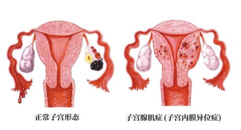 子宫内膜异位症如何治疗怀孕快