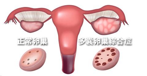 怎么避免多囊卵巢综合征的发生